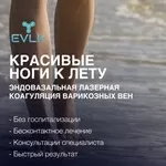 Лечение варикозного расширения вен - ЭВЛК,  Харьков